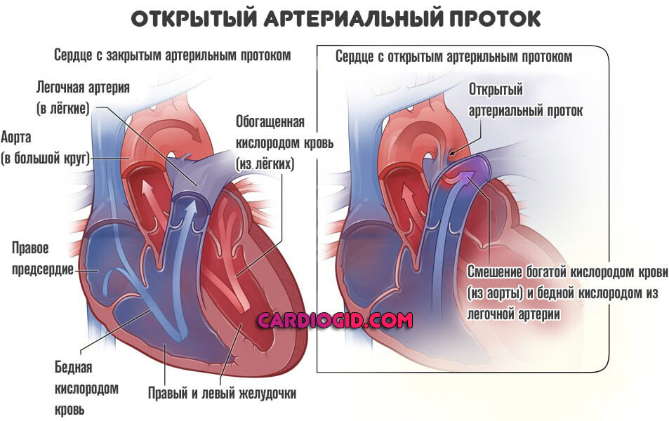 Как выглядит порок сердца на картинке