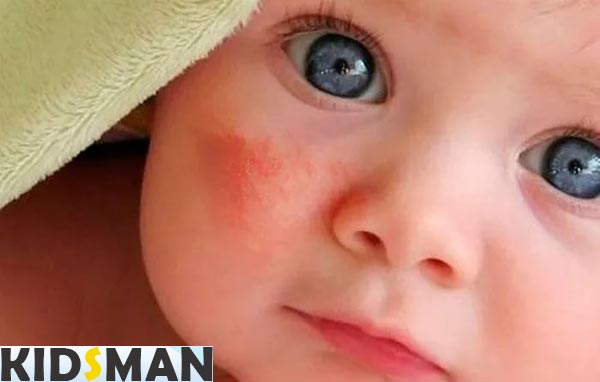 Красные щеки при аллергии у грудного ребенка