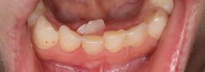 Сколько молочных зубов должно быть у ребенка в 2 года, как происходит процесс прорезывания?