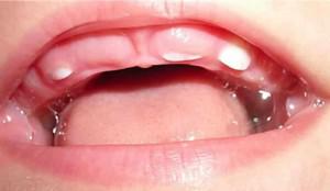 Сколько зубов должно быть у ребенка в 3-4 года, какие зубные единицы лезут в 5 лет?