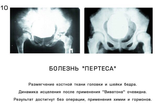 Болезнь пертеса презентация